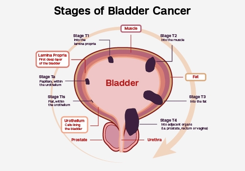 Illustration that describes bladder cancer staging