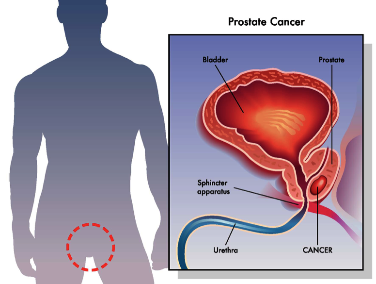 Diagram of prostate and cancer zones