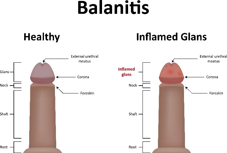 Balanitis
