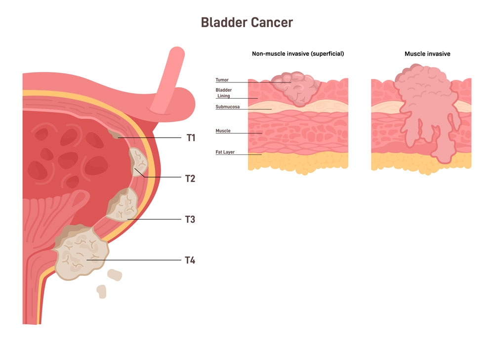 Bladder Cancer