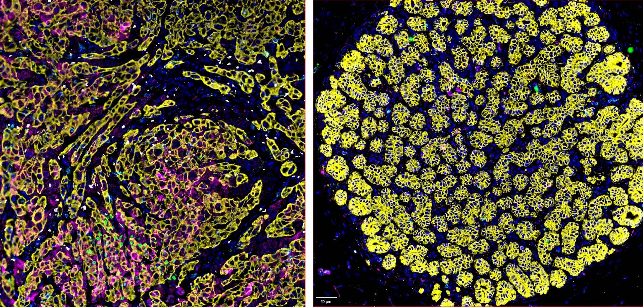 The TNBC cellular microenvironment is complex. Immunosuppressive regulatory T cells (Tregs) abundantly infiltrate TNBC tissue (left) compared with healthy nearby breast tissue (right).