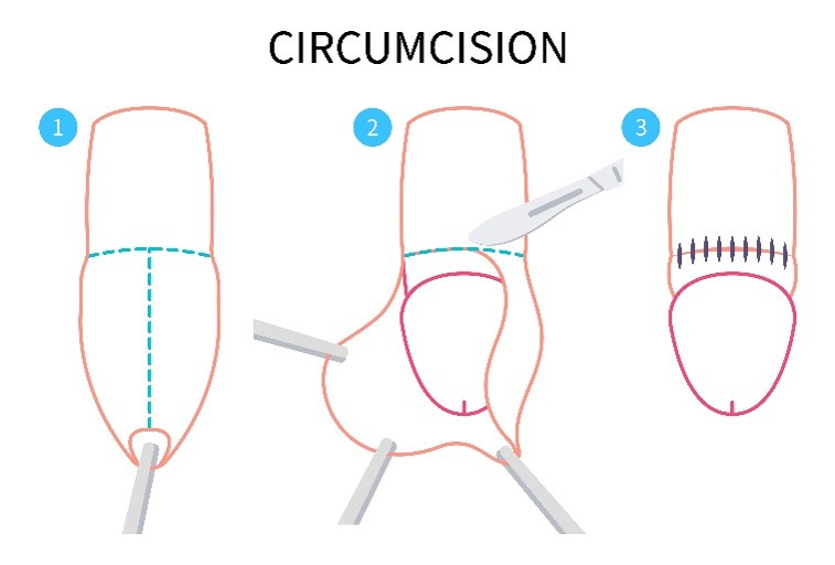 circumcision
