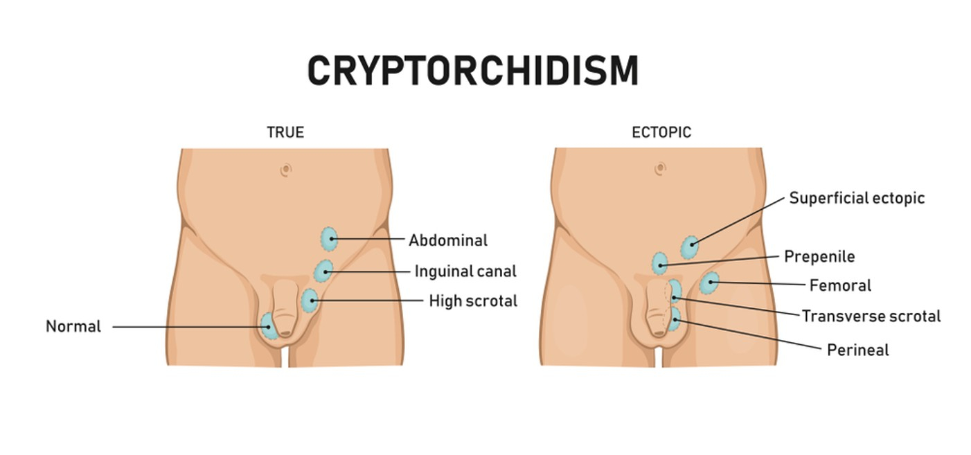 cryptorchidism_image