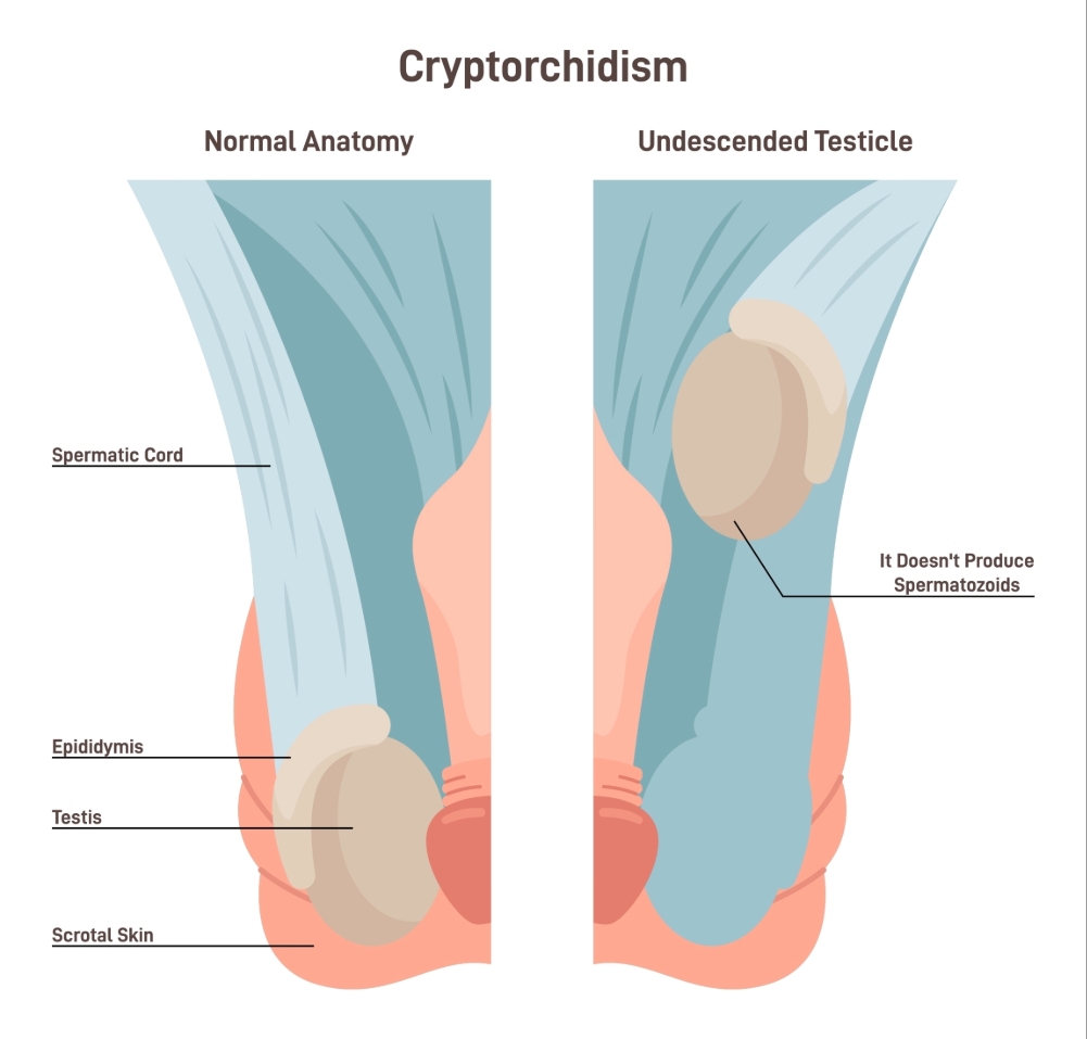 Cryptorchidism Image