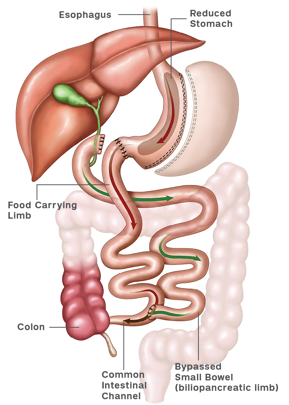 Illustration that shows how a duodenal switch is performed