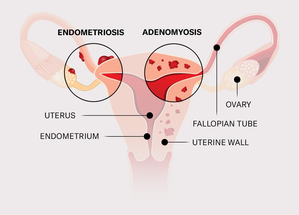endometriosis vs adenomyosis