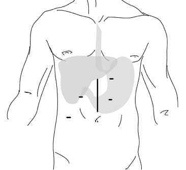 Diagram that shows where an incision may be made when donating a liver