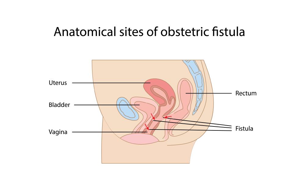 Vaginal Fistula image