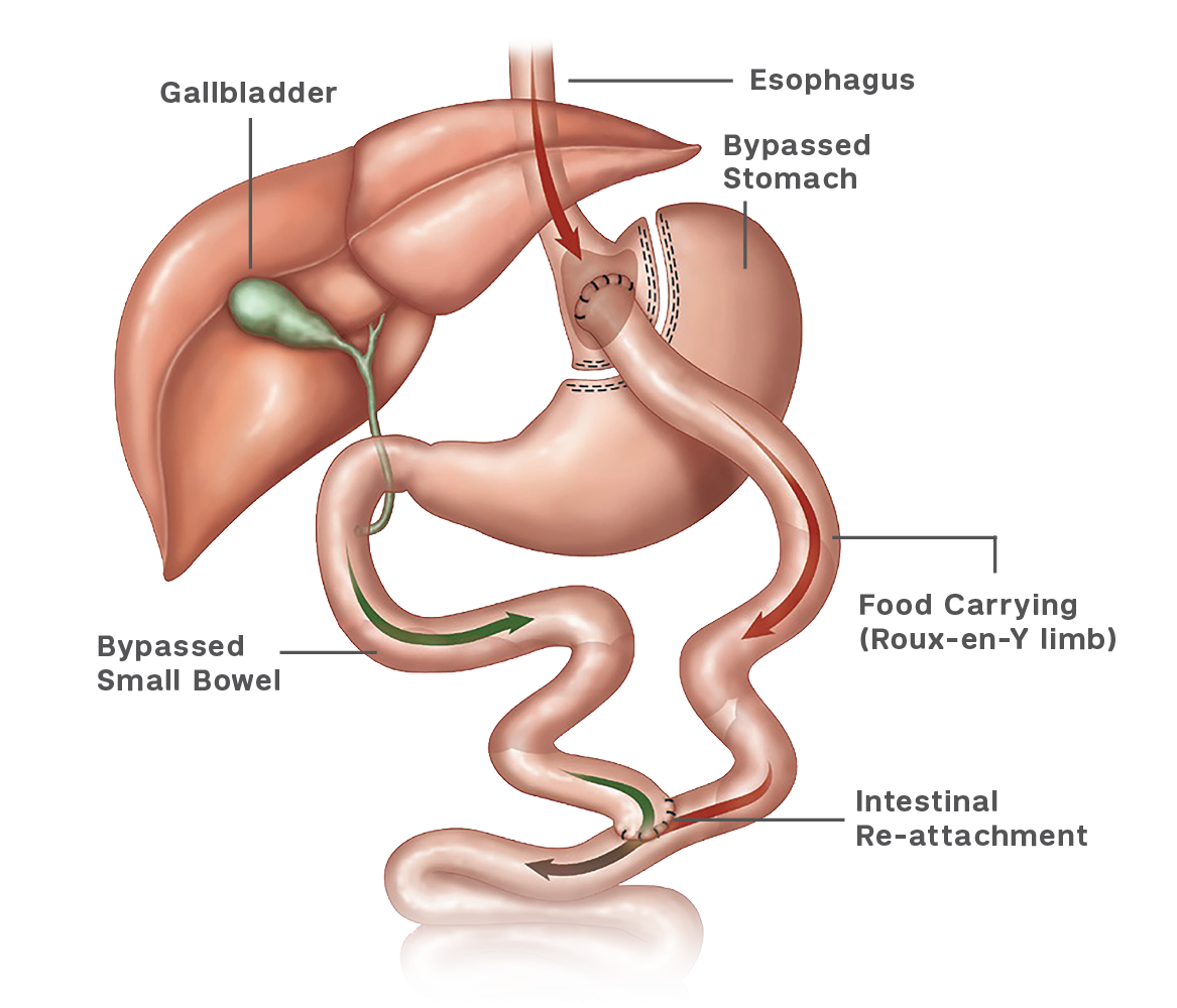 Illustration that shows how gastric bypass is performed