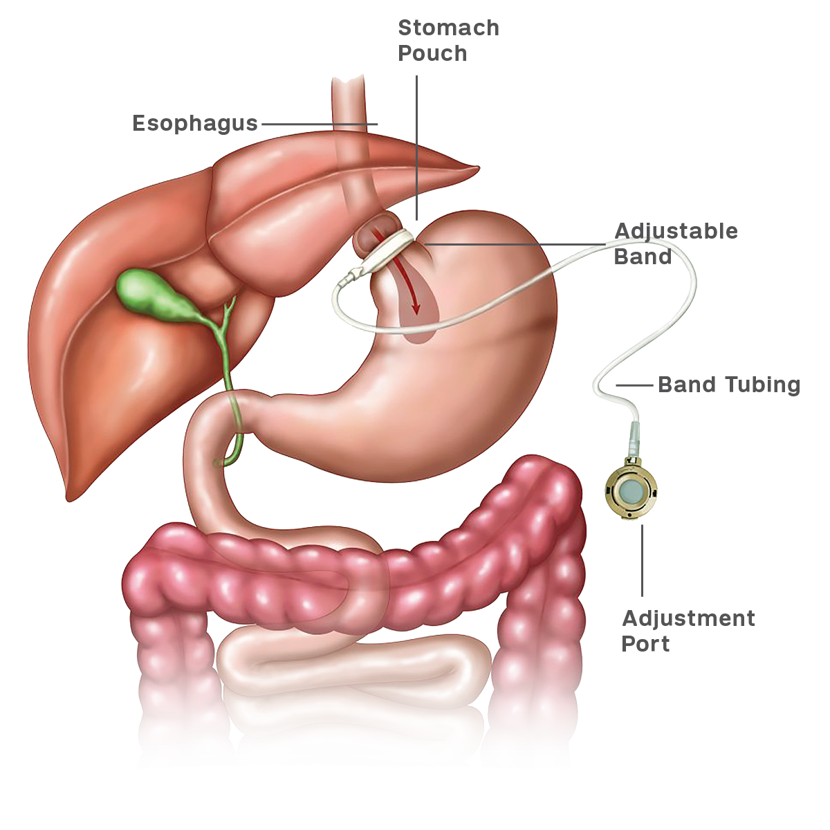 Illustration that shows how a gastric band works