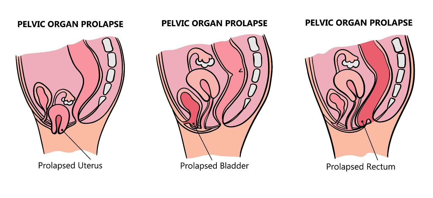 raphic for prolapse image