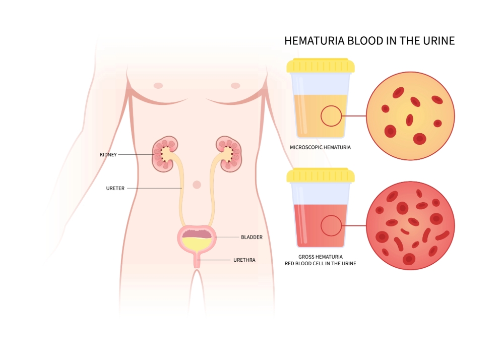 hematuria_image