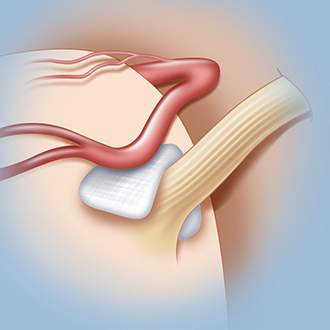 hemifacial spasm surgery