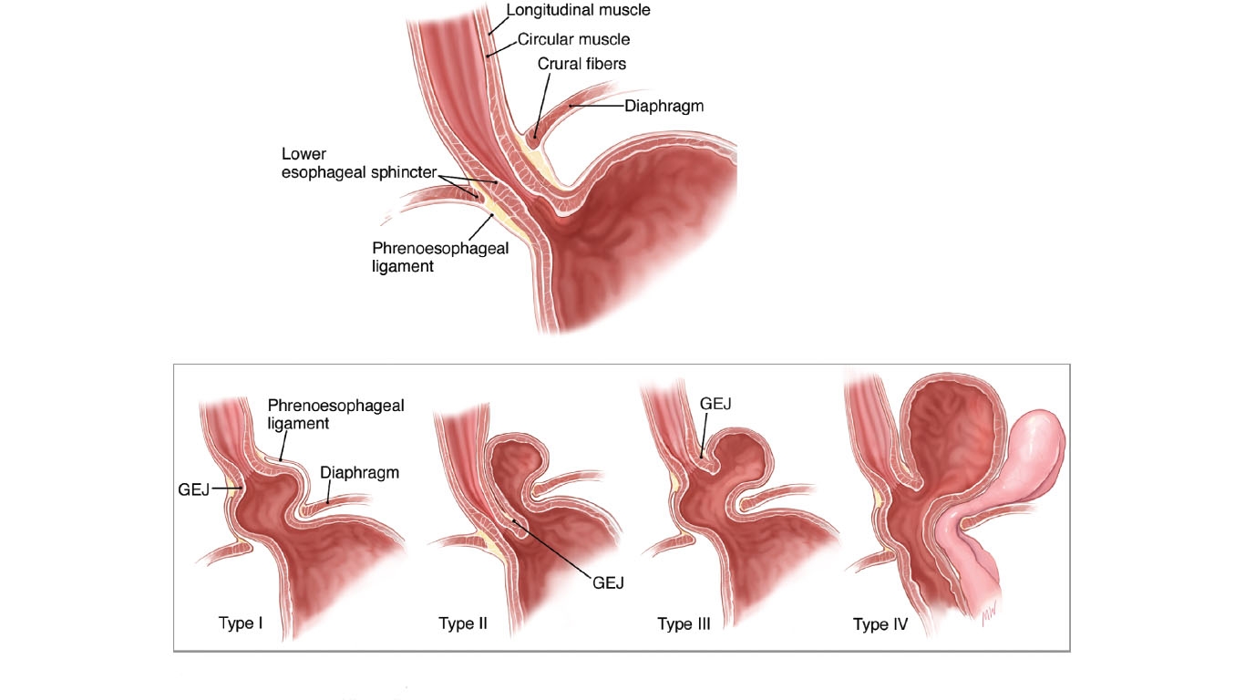 Medical illustration that shows the different types of hiatal and paraesophageal hernias