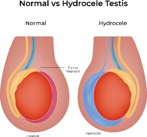 hydroceles_image