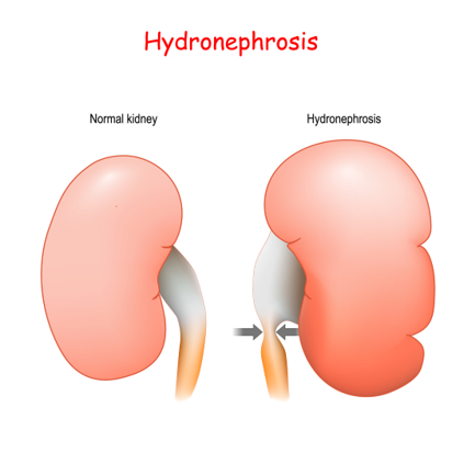Hydronephrosis