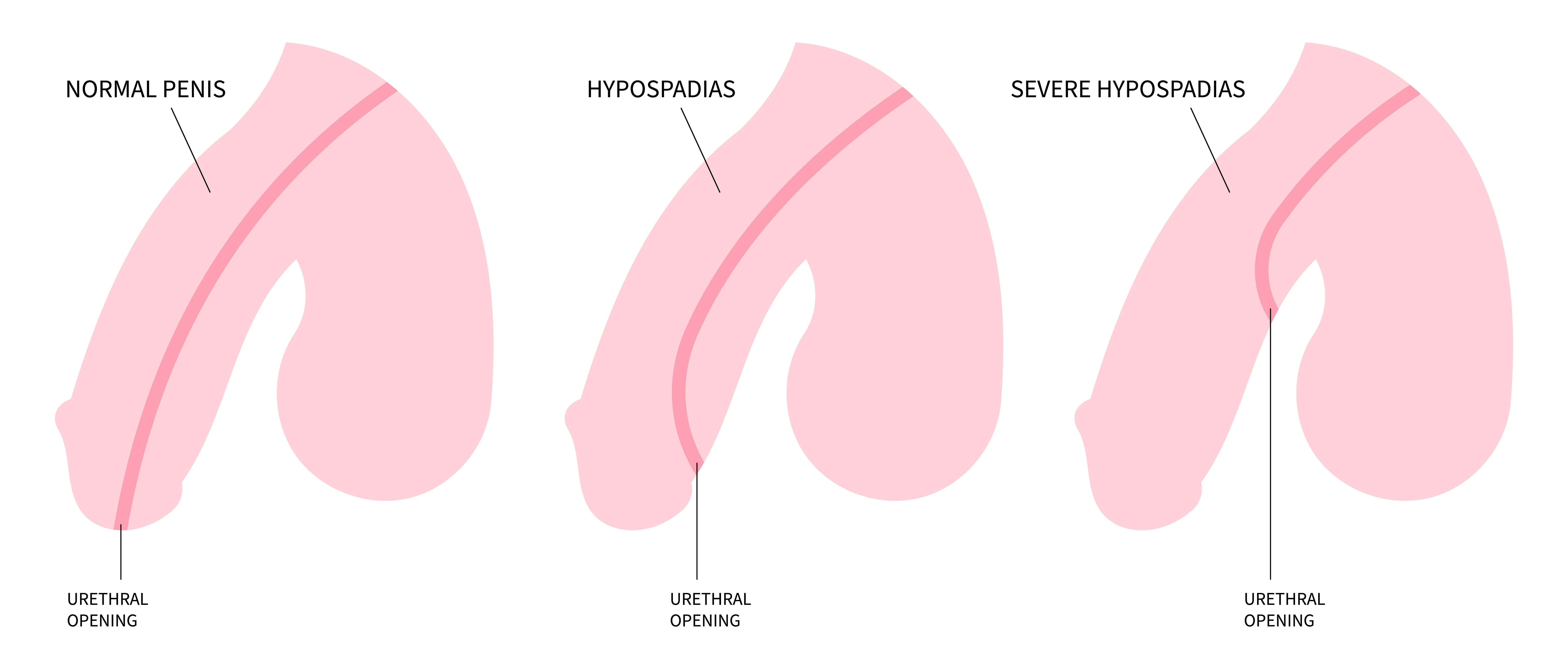 Hypospadias Guideline Hypospadias Guideline