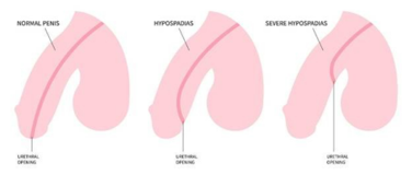 Hypospadias