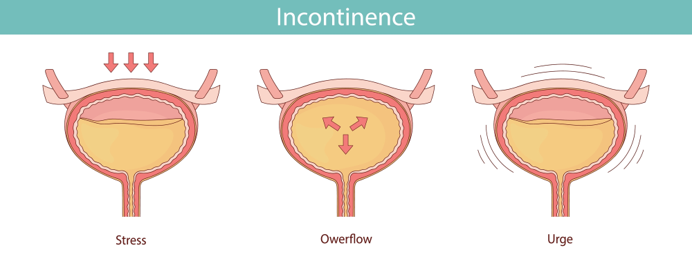 Urinary Incontinence image