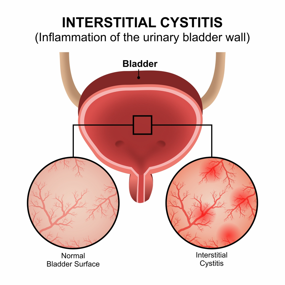 Interstitial Cystitis image