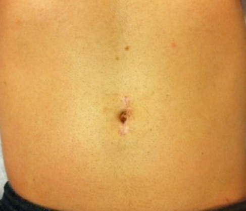 kidney transplant donor scar