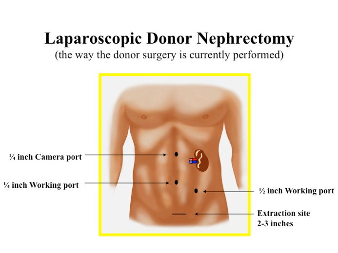 Illustration of laparoscopic donor nephrectomy