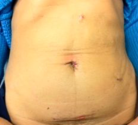 kidney transplant scar healed