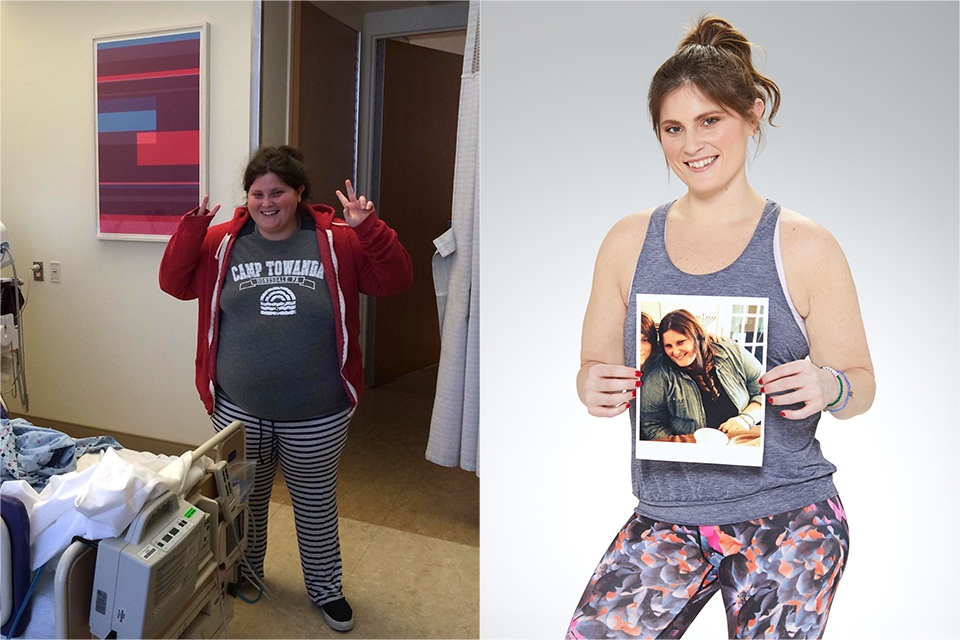 Before and after photo of a patient who underwent bariatric surgery at Weill Cornell Medicine