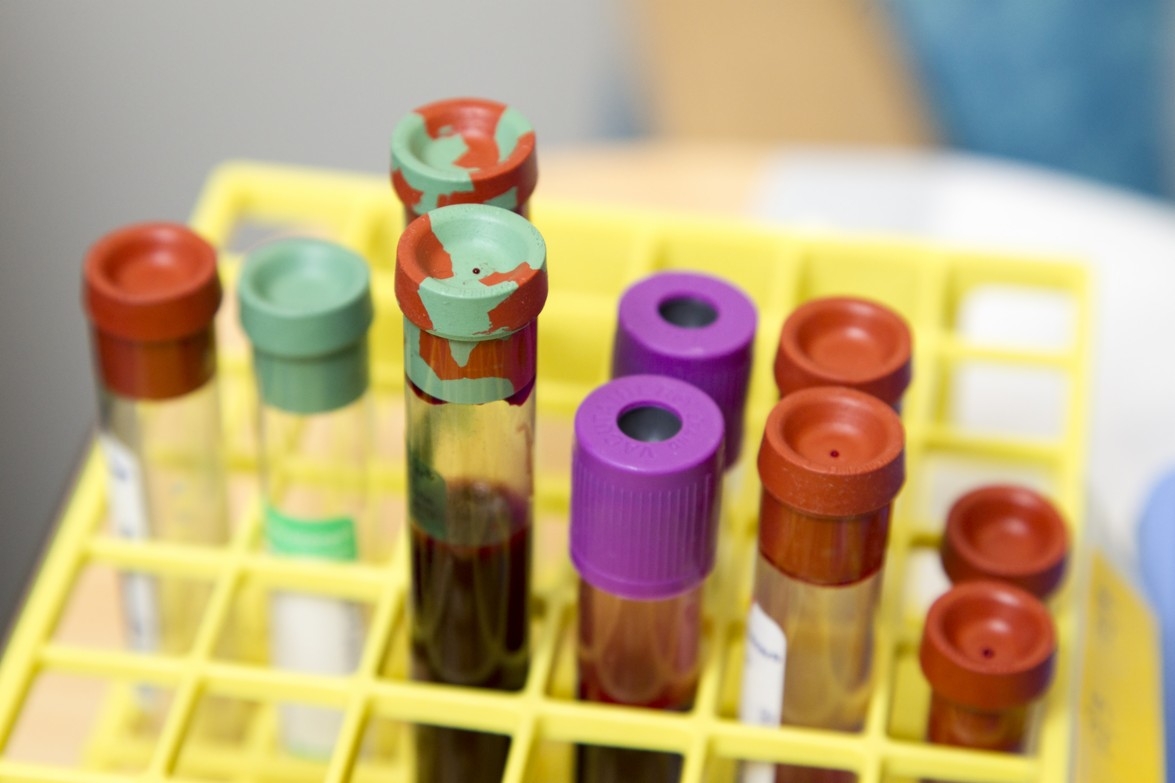 What a Simple Blood Test Can Reveal About Chemo and Prostate Cancer