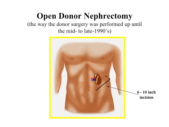 Illustration of an open donor nephrectomy