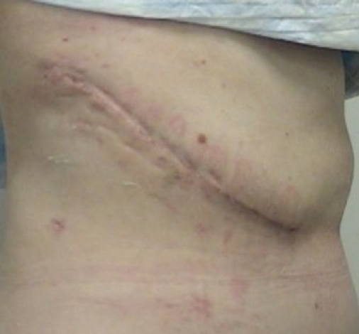 kidney transplant donor scar