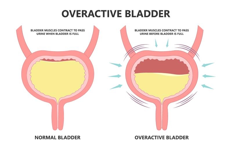 overactive bladder image