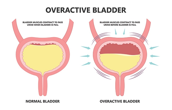 overactive bladder picrure
