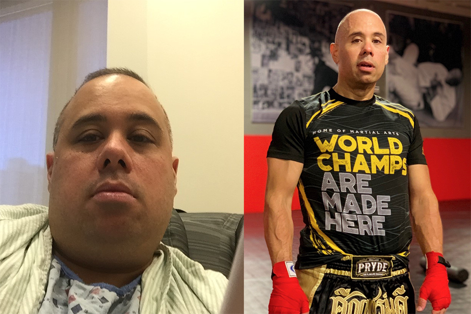 Before and after photo of a patient who underwent bariatric surgery at Weill Cornell Medicine