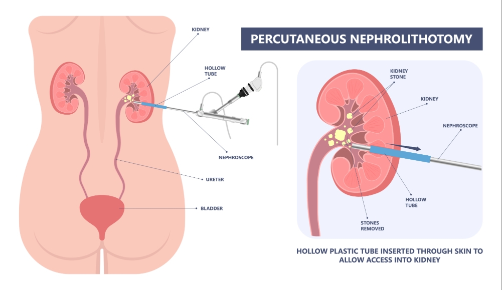 Percutaneous Nephrostolithotomy image