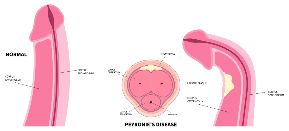 peyronie's disease image