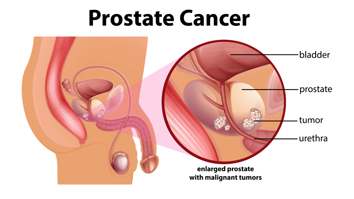 Prostate Cancer