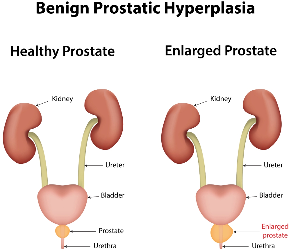 Prostatic Hyperplasia image