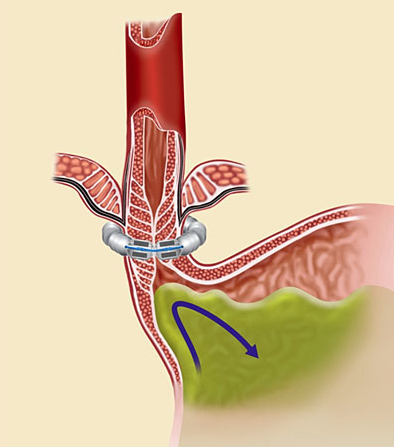 Medical illustration demonstrating the Robotic LINX procedure