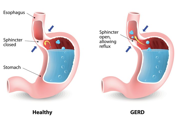 Illustration showing the difference in the esophagus between a patient with GERD and a healthy individual