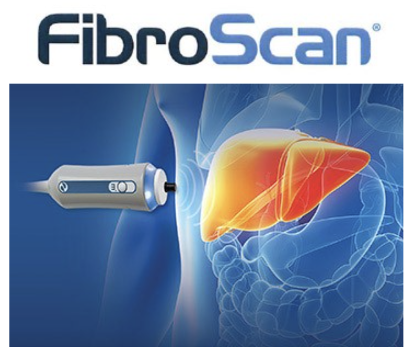 Fibroscan