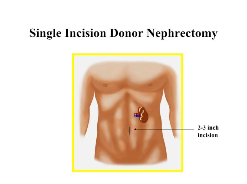 Illustration of Single Incision Donor Nephrectomy