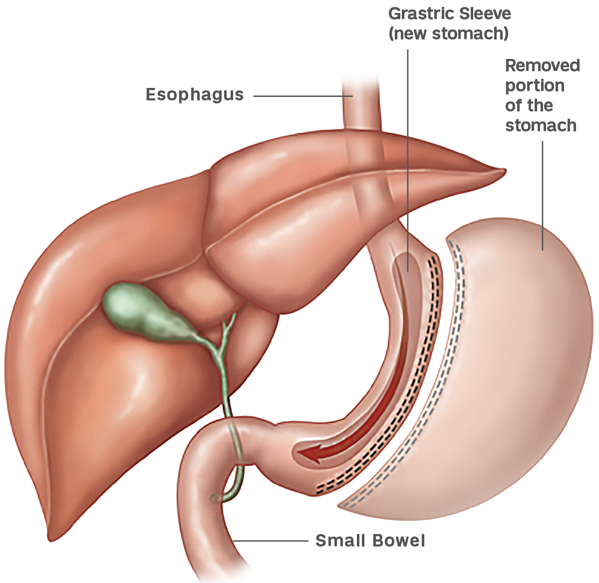 Illustration that shows how sleeve gastrectomy is performed