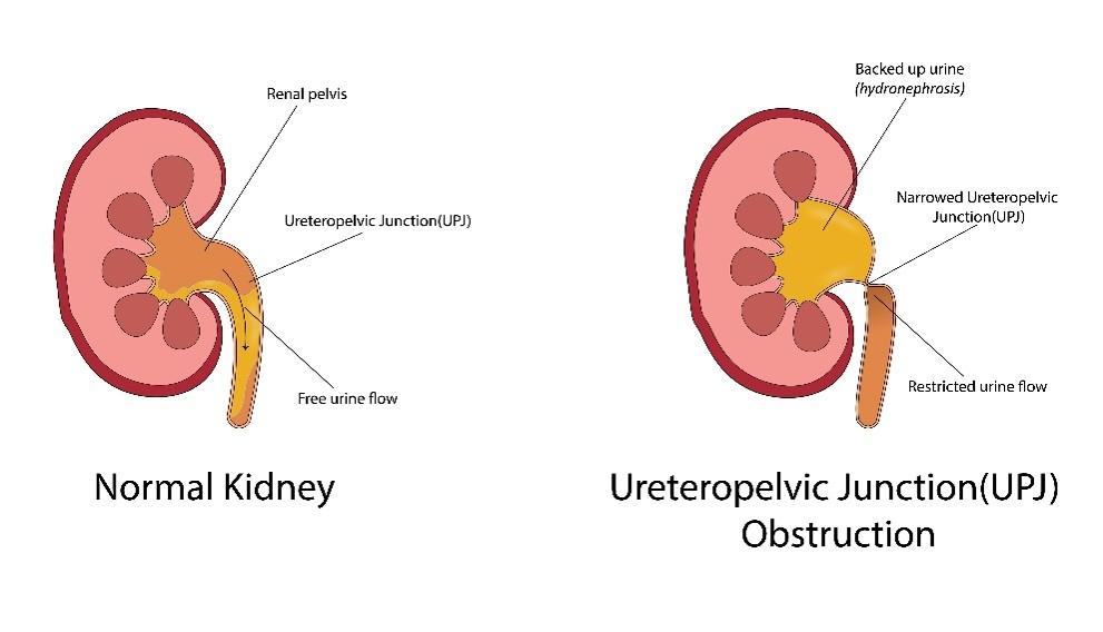 Ureteropelvic Junction Obstruction