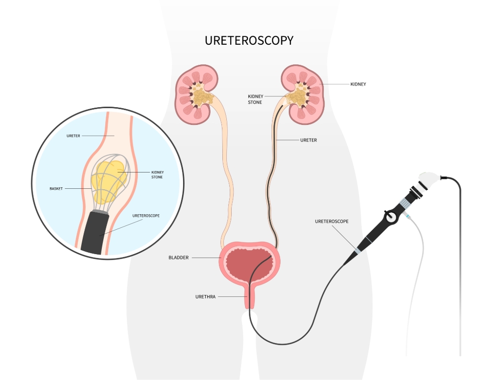 Ureteroscopy image