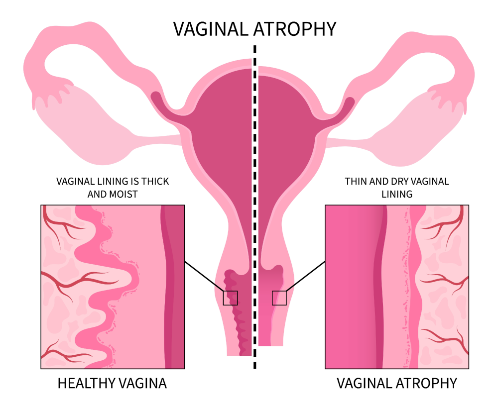 vaginal atrophy image