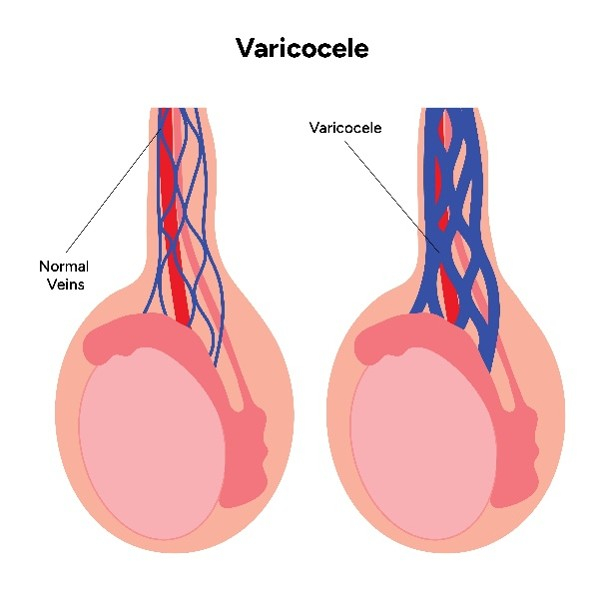 varicocele_image