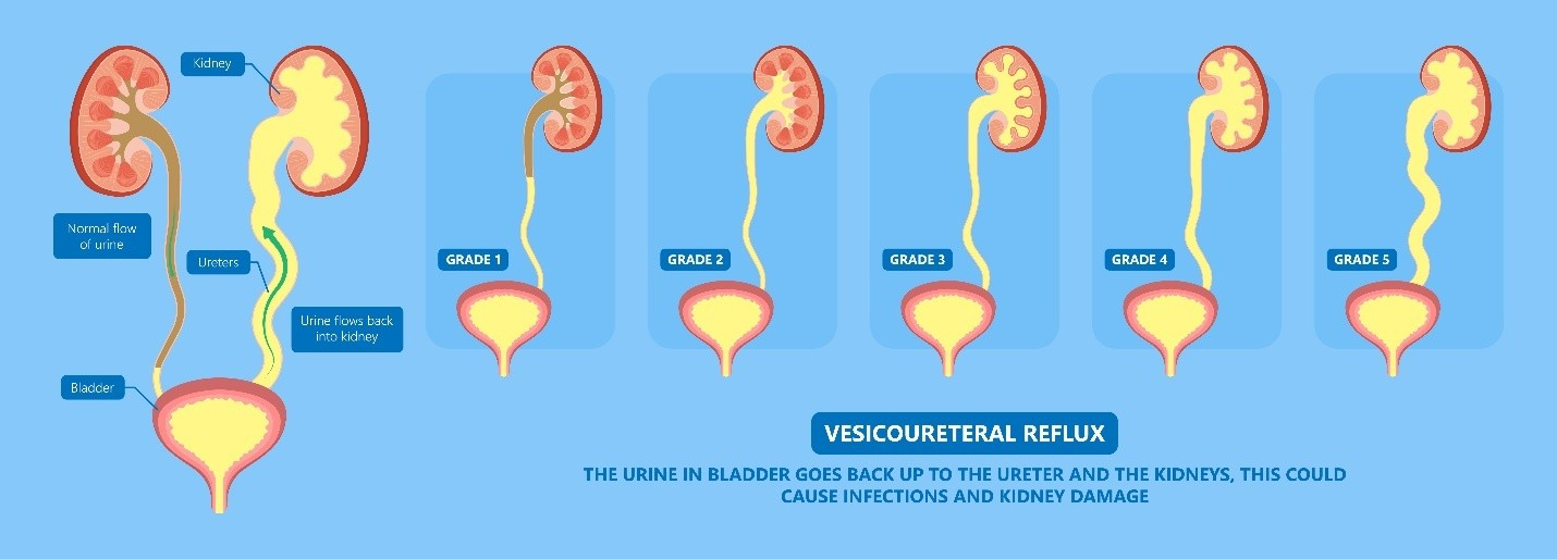 Vesicoureteral reflux