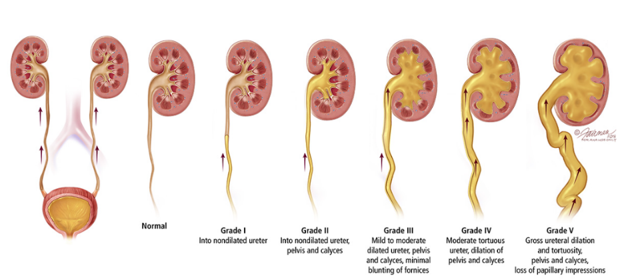 Vesicoureteral reflux
