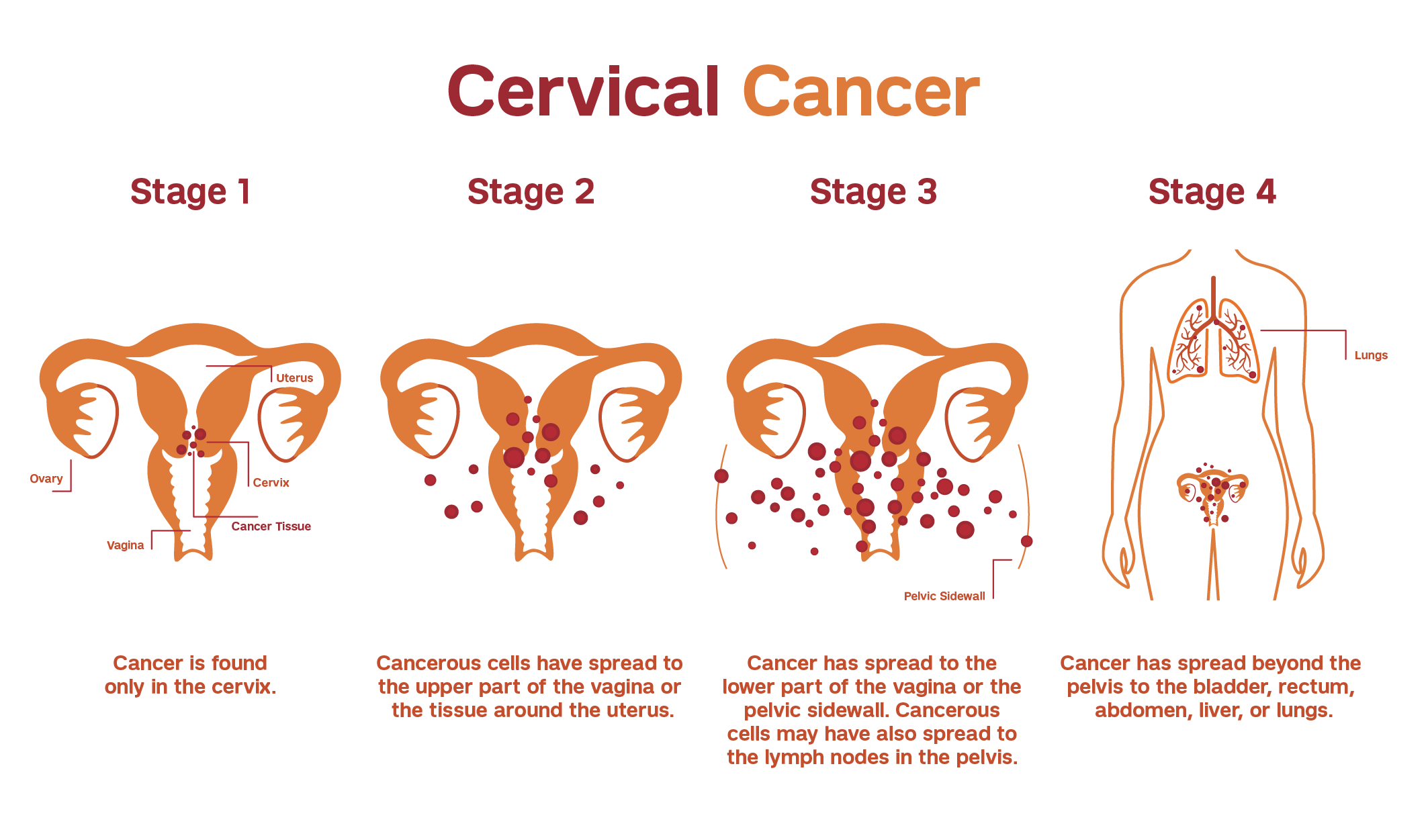keynote 158 cervical cancer